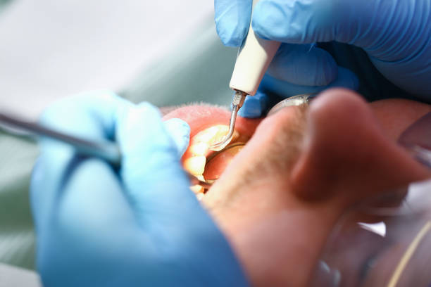 Best Emergency Dental Care for Broken or Chipped Teeth in Stuarts Draft, VA