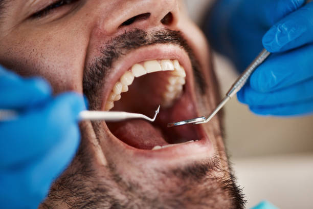 Best Emergency Wisdom Teeth Removal in Stuarts Draft, VA